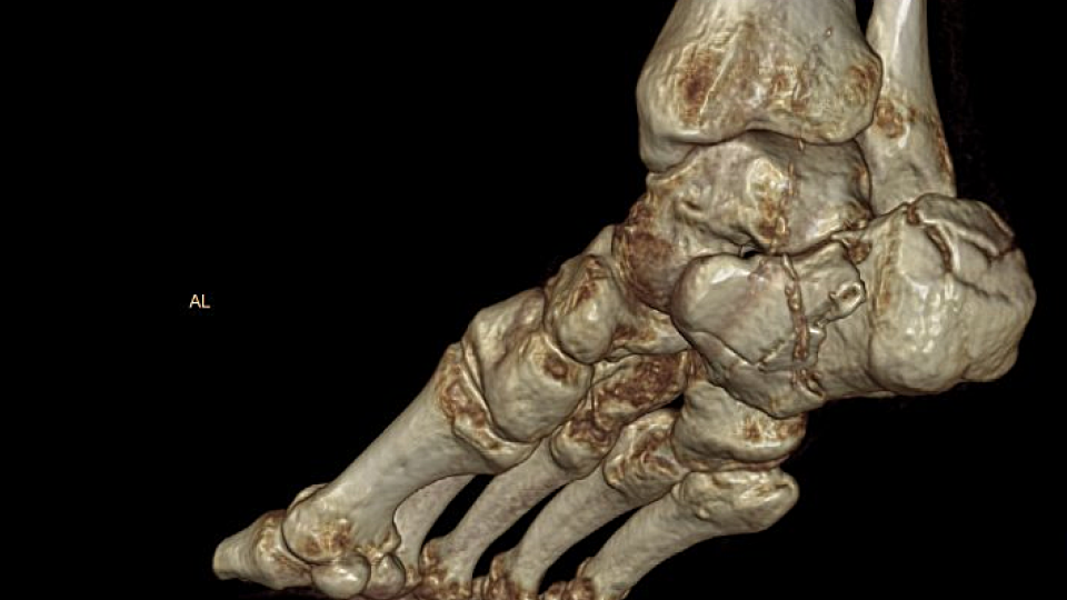 3D zobrazení patní kosti