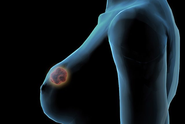 Rakovina prsu | foto: Fotobanka Profimedia