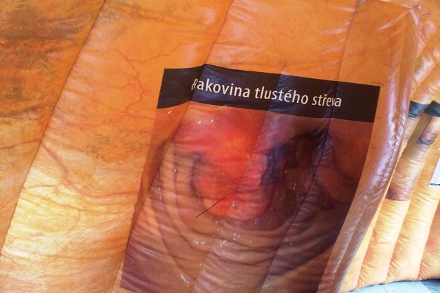 Rakovina tlustého střeva | foto: Hana Ondryášová,  Český rozhlas