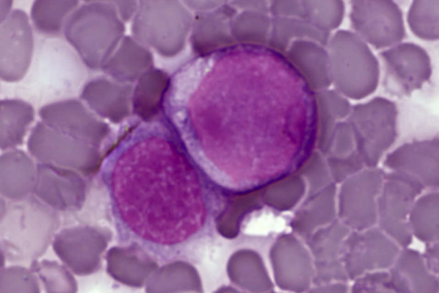 Leukemické buňky v nátěru z periferní krve | foto:  PLoS Biology