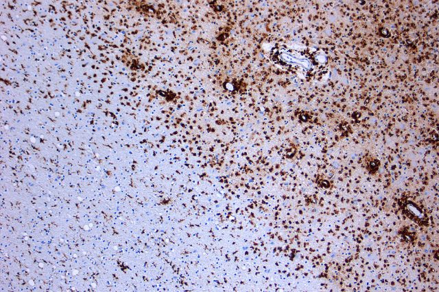 Mikrofotografie demyelinizace  (ztráta myelinu z nervových vláken axonů) při roztroušené skleróze | foto:  Marvin 101