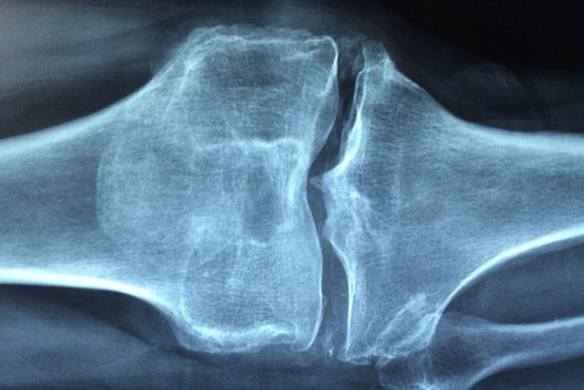 Onemocněním kostí a kloubů trpí statisíce Čechů,  mnozí o své diagnóze ani netuší | foto: Fotobanka Pixabay