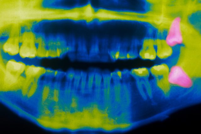 Někteří lékaři radí zuby moudrosti hned vytrhnout | foto: Profimedia