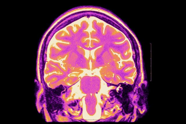 Mozek při vyšetření magnetickou rezonancí | foto: Profimedia