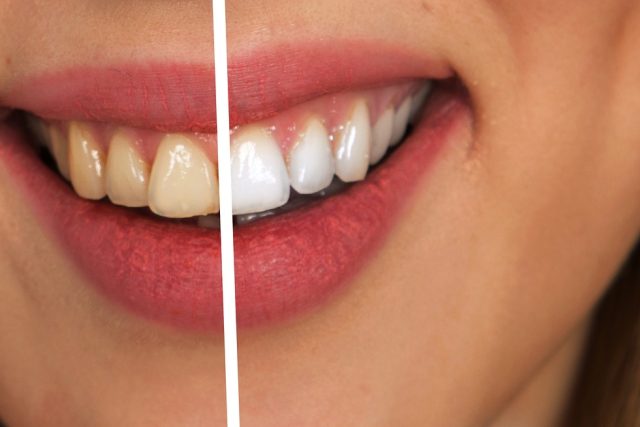 Moderní metodou,  jak si udržet krásný úsměv,  je bělení zubů | foto: Fotobanka Pixabay